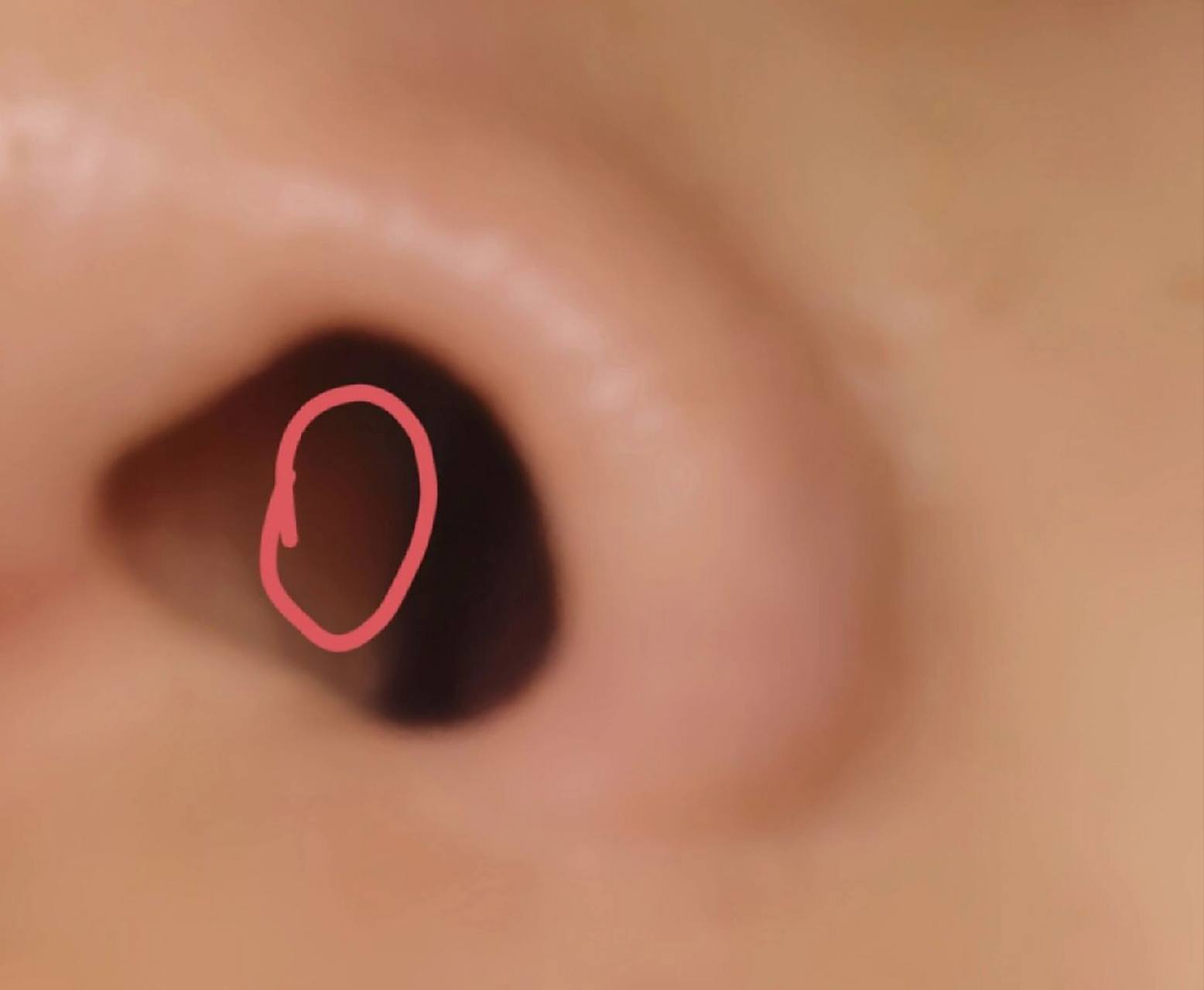 鼻子里面好像一坨软骨肿着 宝子们 有天换衣服不小心打到鼻子 咔嚓的