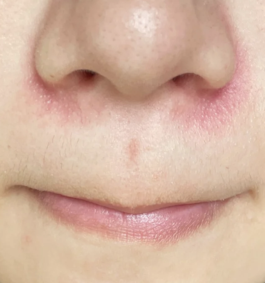 鼻子下面红红的常见原因包括皮肤敏感,局部刺激或痤疮