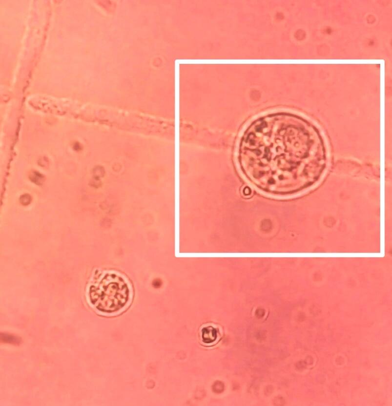 尿液检验第四篇:尿24h沉渣计数中复粒细胞 8715在尿液24小时沉渣