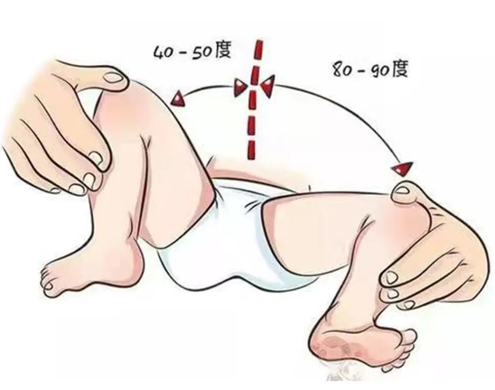 为什么女宝宝髋关节发育不良