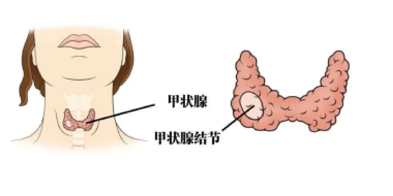 96怎样知道自己的甲状腺有没有问题?