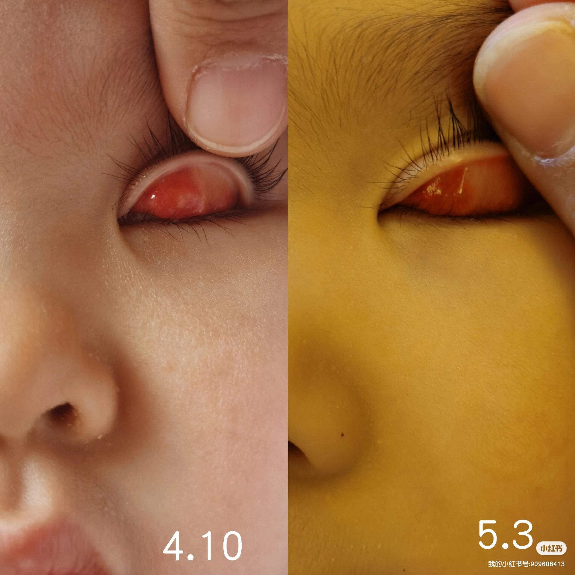 一岁三个月 霰粒肿睑板炎囊肿 治疗中