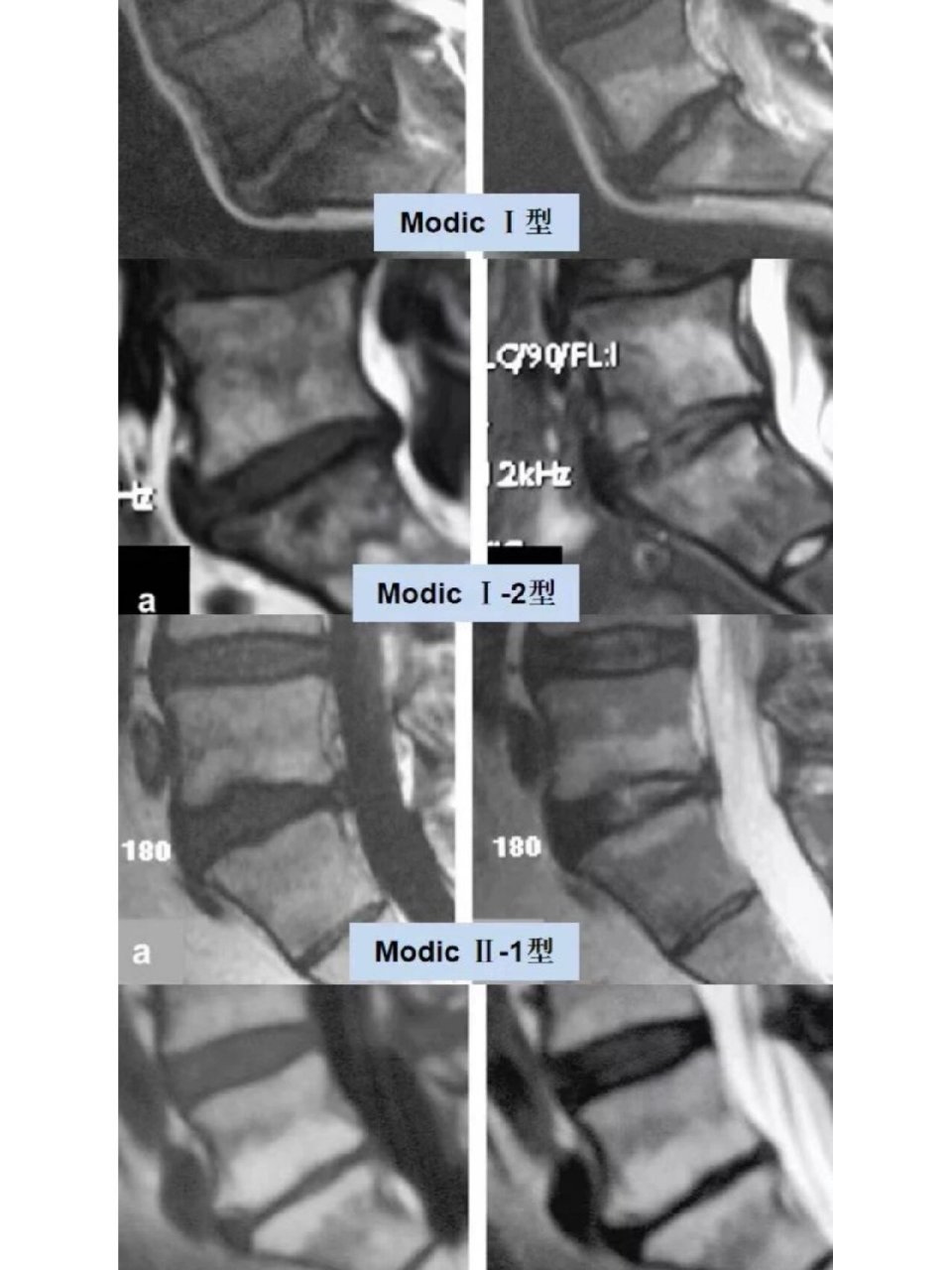 什么是椎体终板炎: 椎体终板炎也称之为 modic 改变或终板退变,是