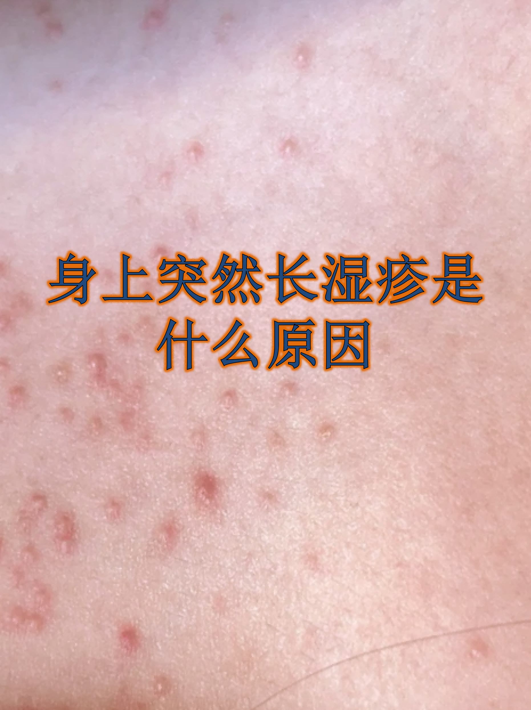 身上突然长湿疹是什么原因