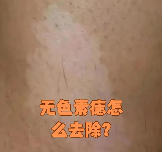 无色素痣可以通过几种方法去除,具体选择要看情况