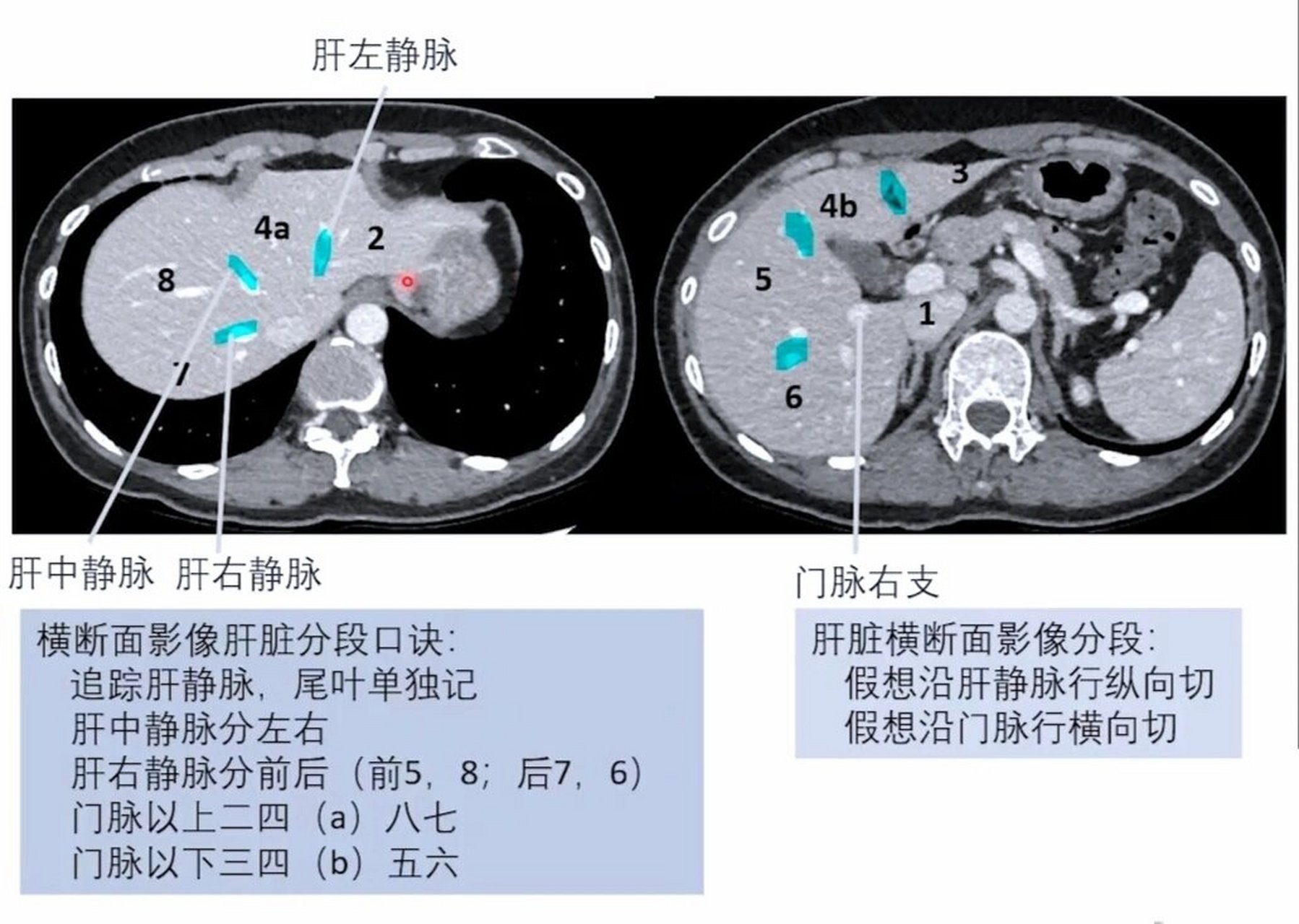 肝叶分段口诀图片