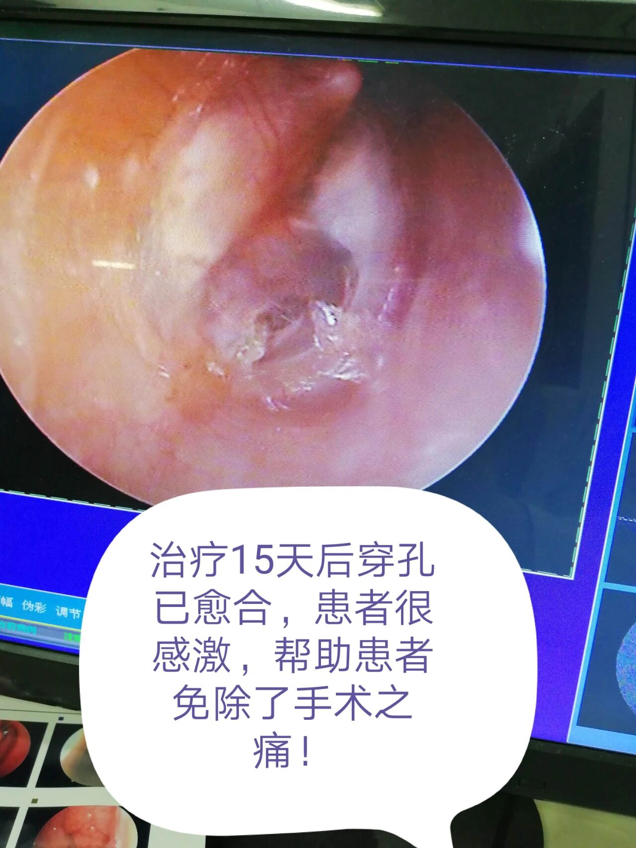 鼓膜穿孔后怎么办?