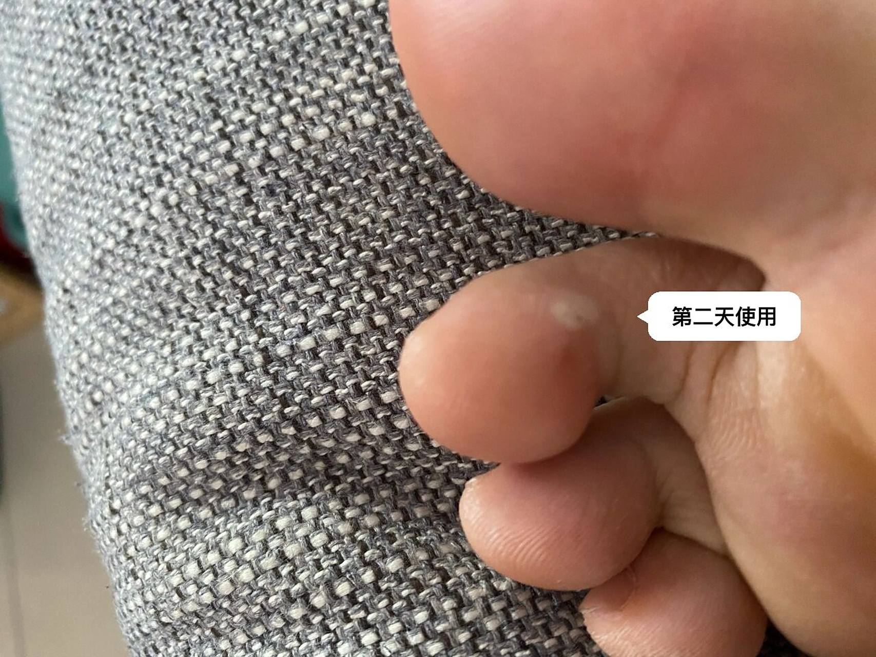 脚上的鸡眼好痛 买来药膏试试 最近打开,看到很多朋友都有这个问题.