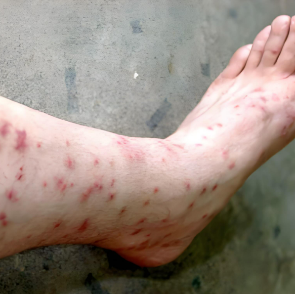 红点通常是因为hiv感染影响了血液凝血功能,导致皮肤出现出血点