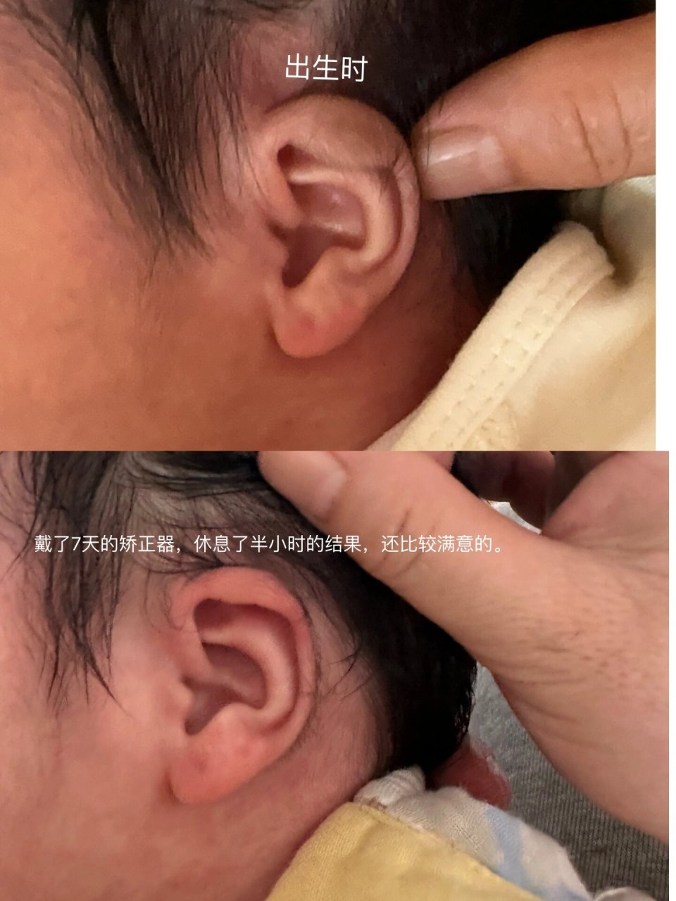 新生儿矫正耳朵  出生时有一只耳朵是垂耳,在医院呢检测听力说没问题