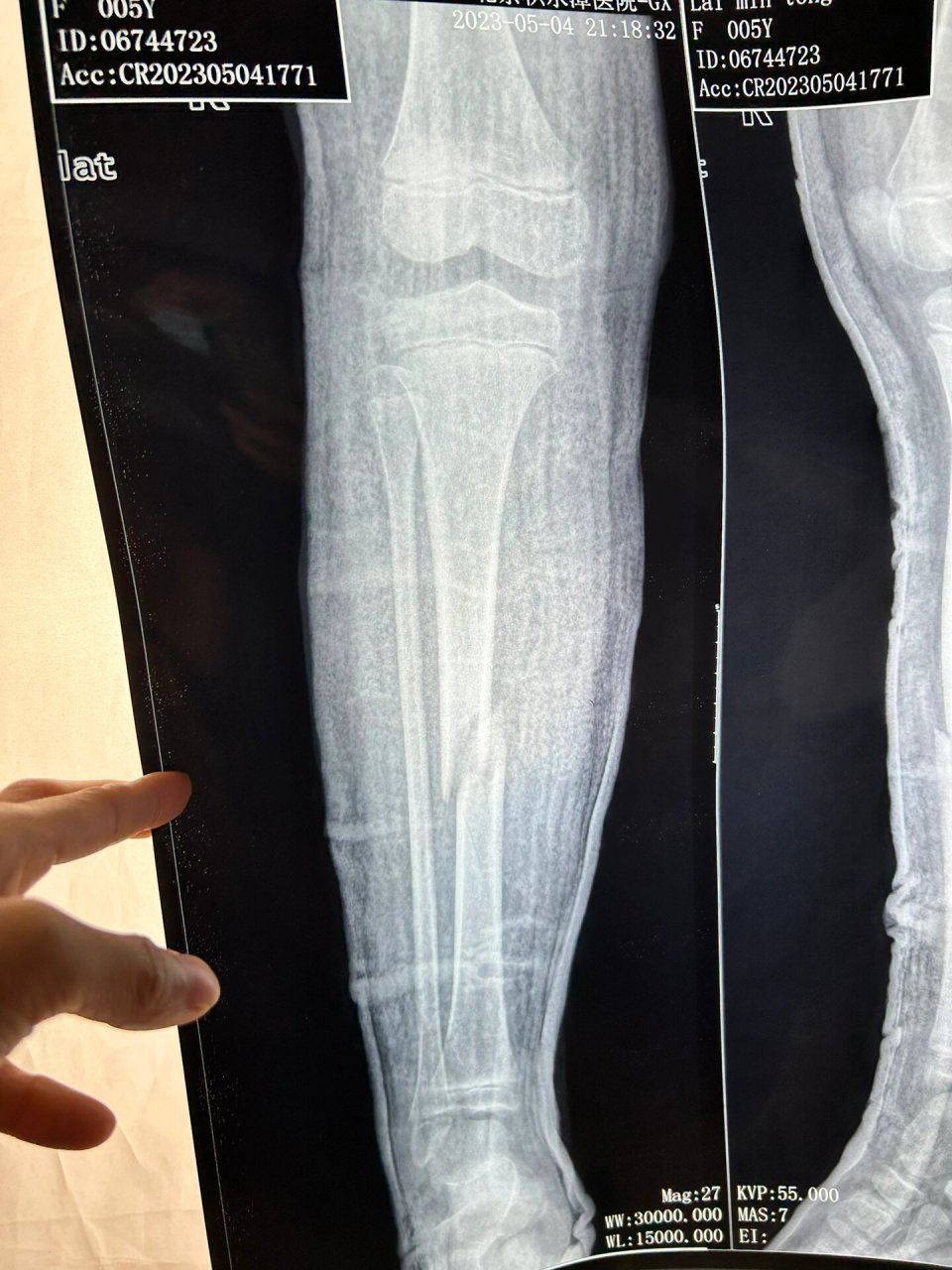 6岁小腿骨折 图片是5月4日当天骨折的片子,图片有明显错位,在北京