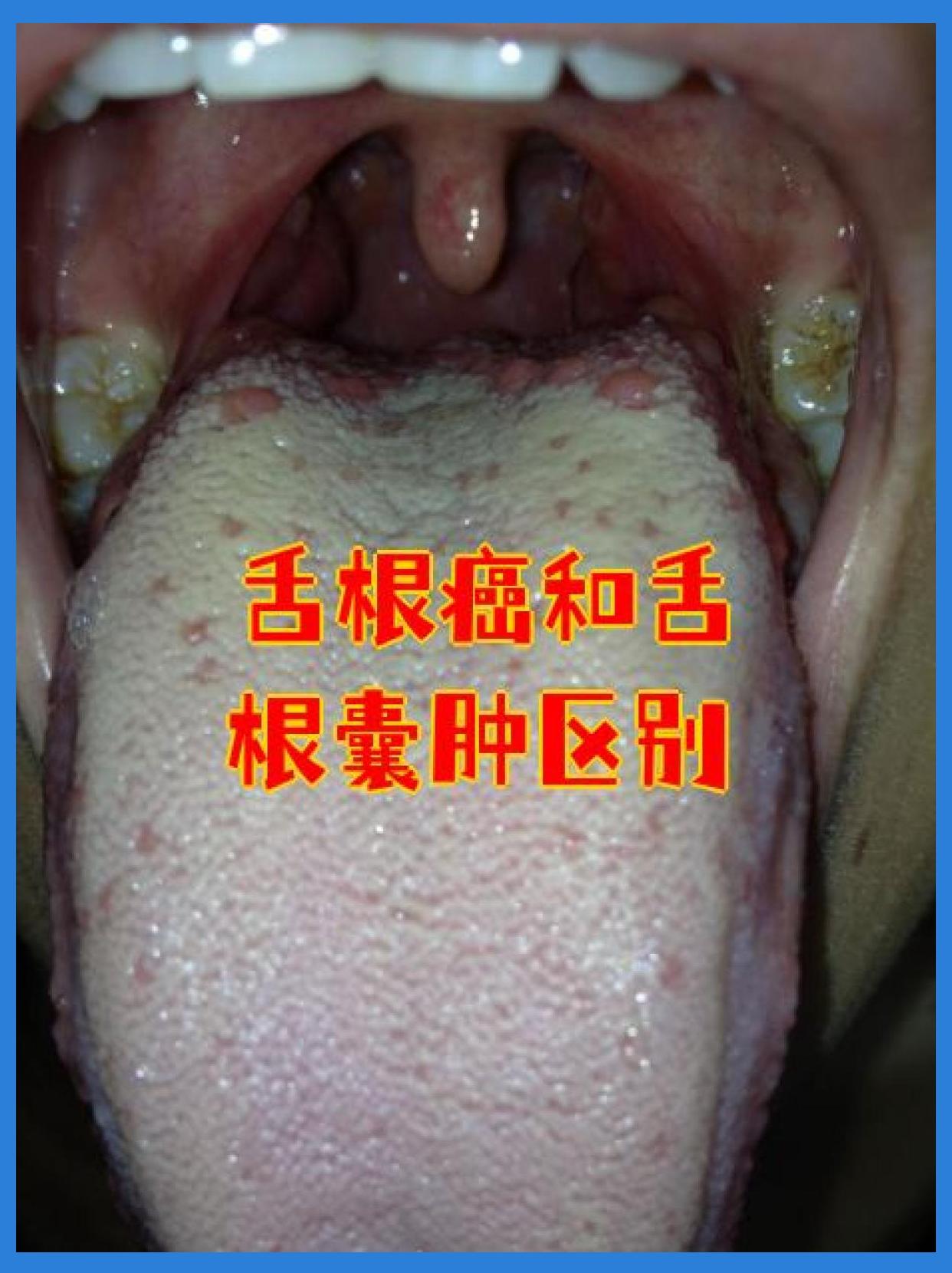 舌根癌是恶性病变与吸烟饮酒或hpv感染有关