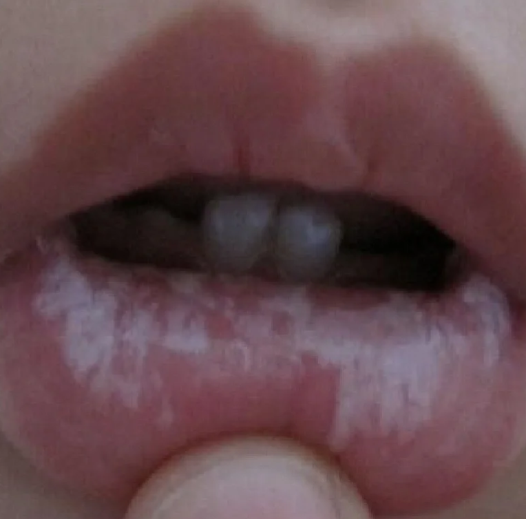 刷牙后口腔出现白膜,可能是正常现象,也可能是疾病引起的