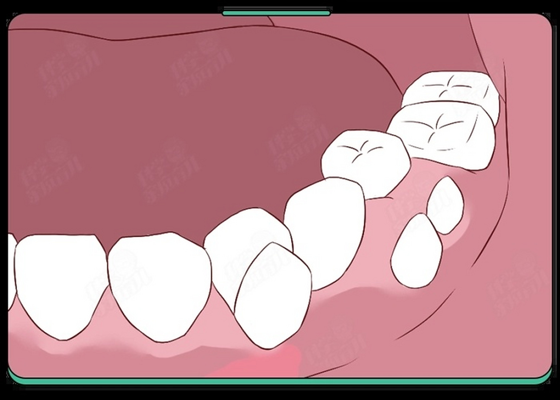 儿童乳牙未掉恒牙长出来了双排牙该怎么办?