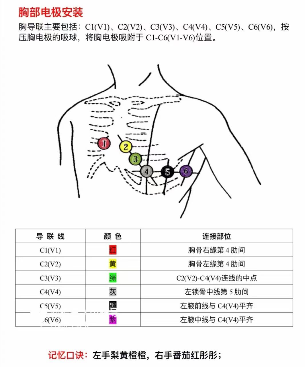 心电图12导联连接彩色示意图