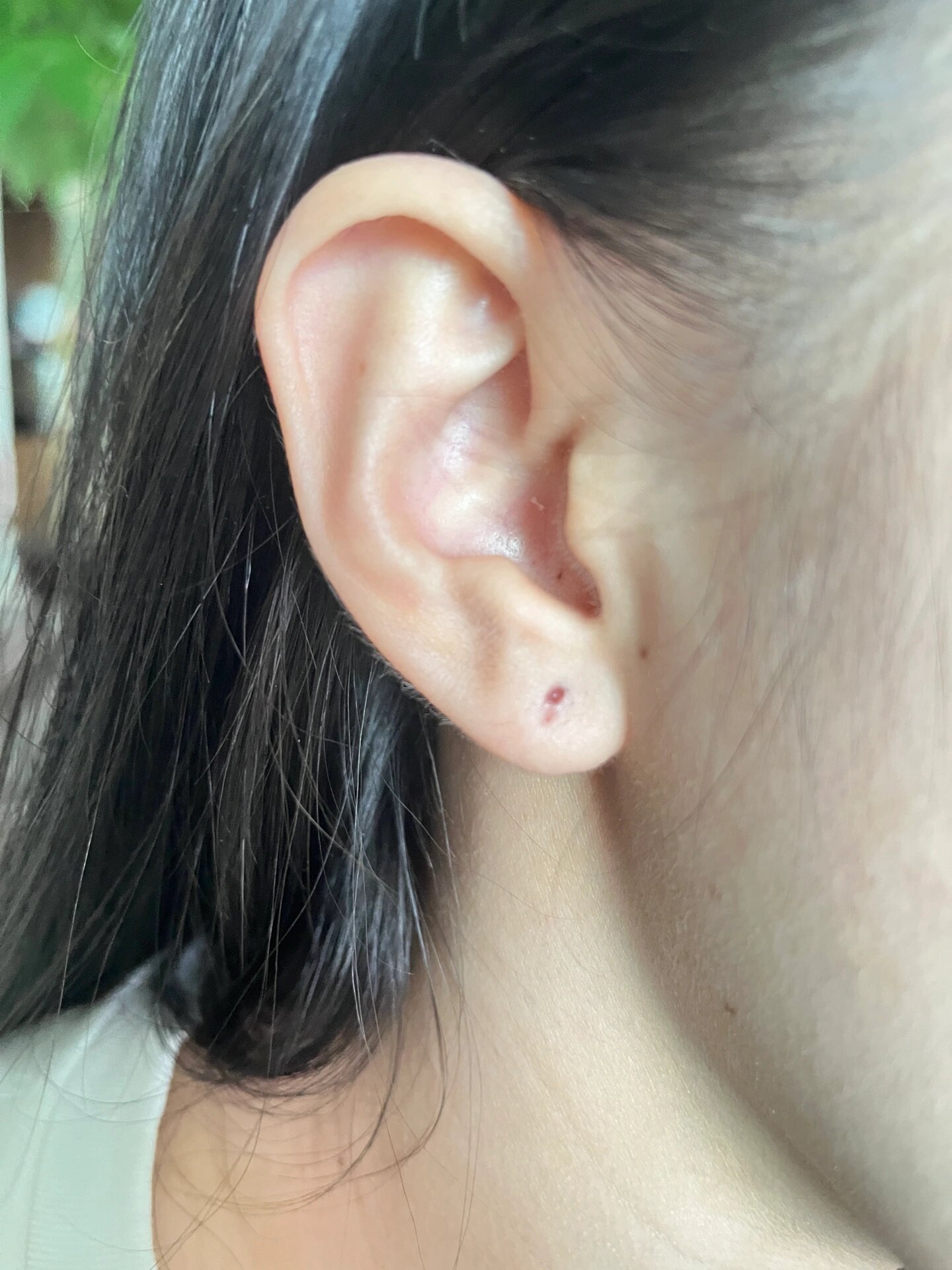 就在前天我睡觉压到了第二天起来耳朵热热的肿