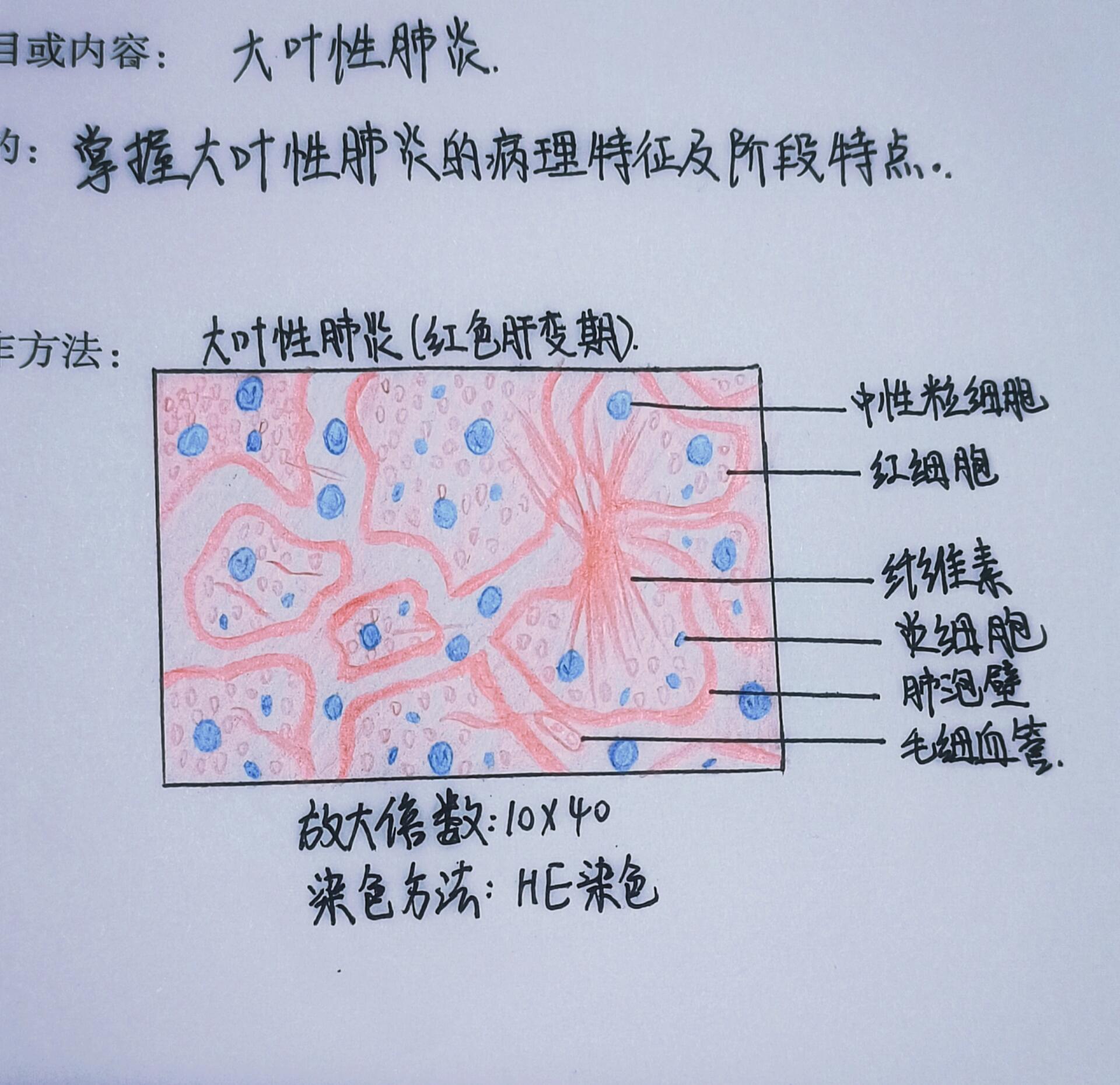 大叶性肺炎病理图图片