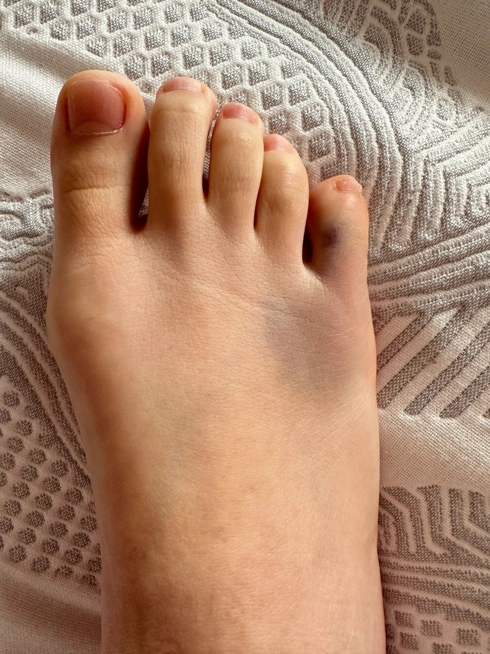 小脚趾头会是骨裂或骨折吗?