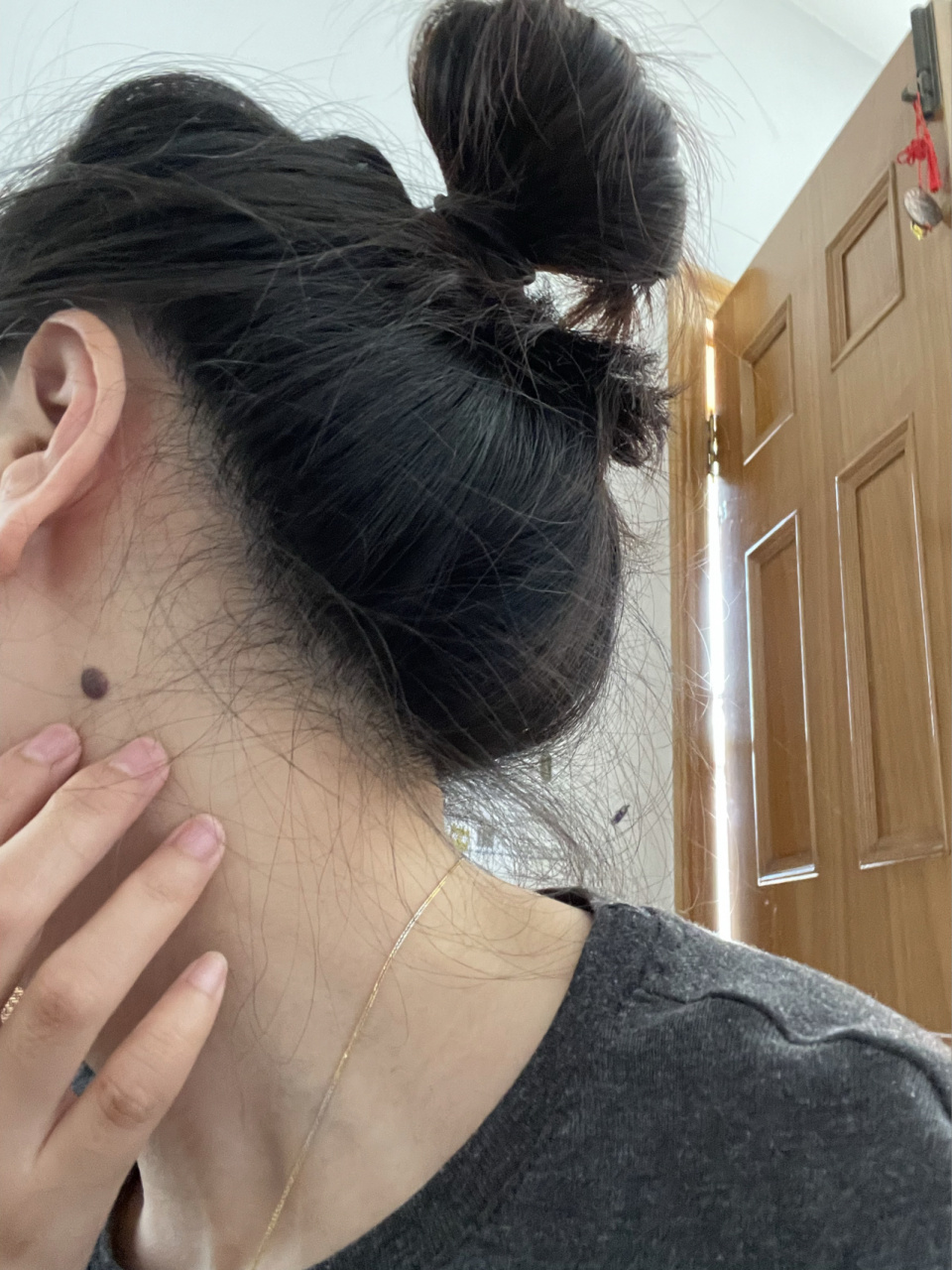 脖子里的大黑痣,从小到大就有 这个有点凸起的,要去除嘛?