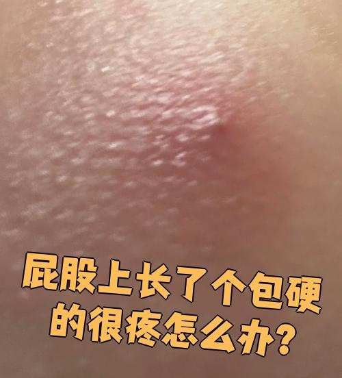 屁股上长了个硬包而且很疼,最常见的原因有三种:毛囊炎,皮脂腺囊肿