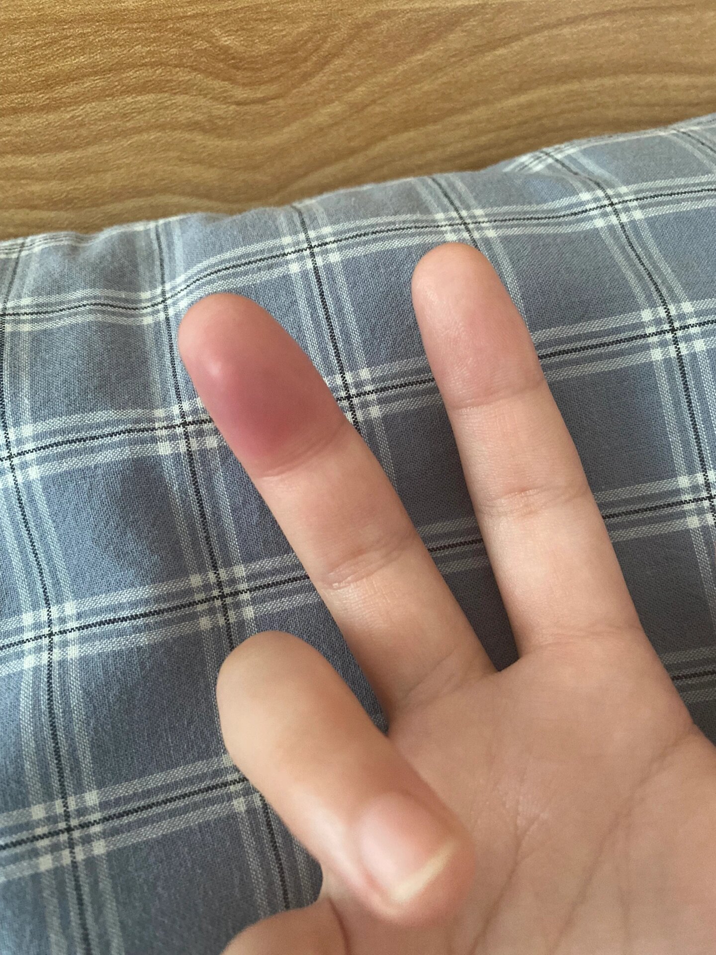 手指头肿胀疼痛是怎么回事