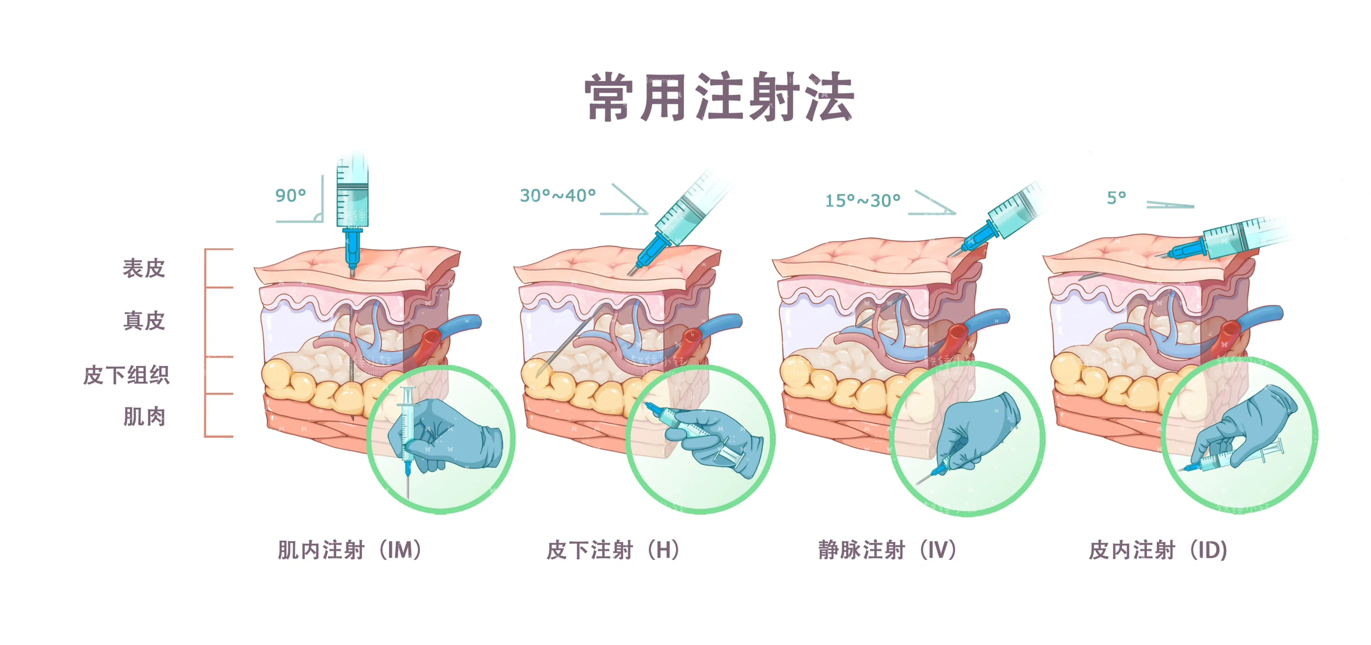 医学插画i四种常见注射法的注射角度 注射部位 肌内注射【im】:臀大肌
