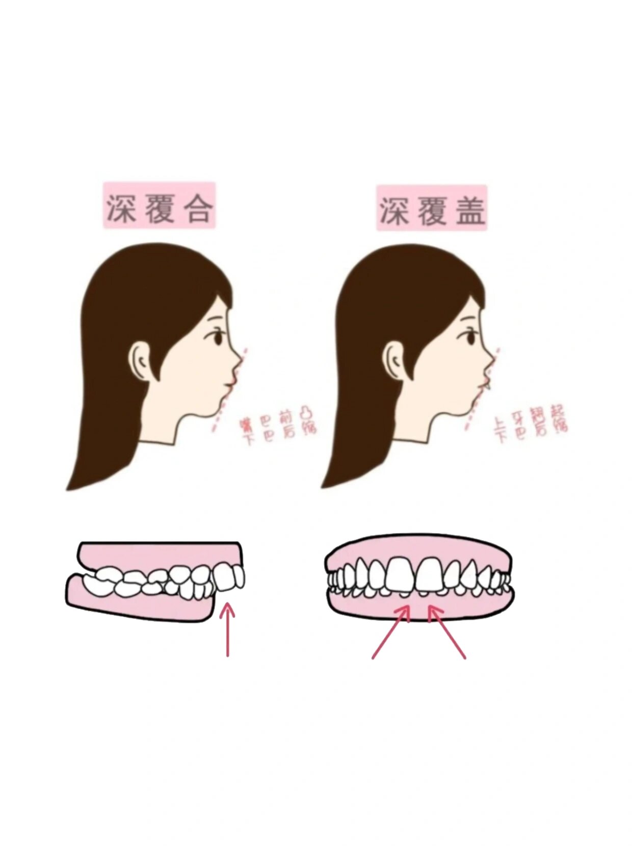 深覆合侧脸对比图片