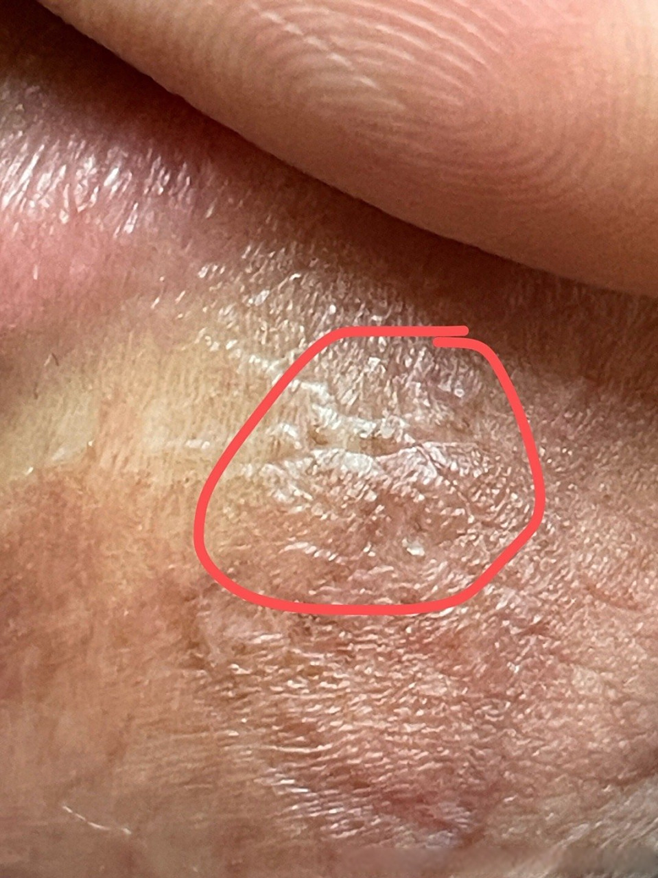 尖锐湿疣并做了激光,后来用药后一直没有复发,2021年10月做过hpv阴性