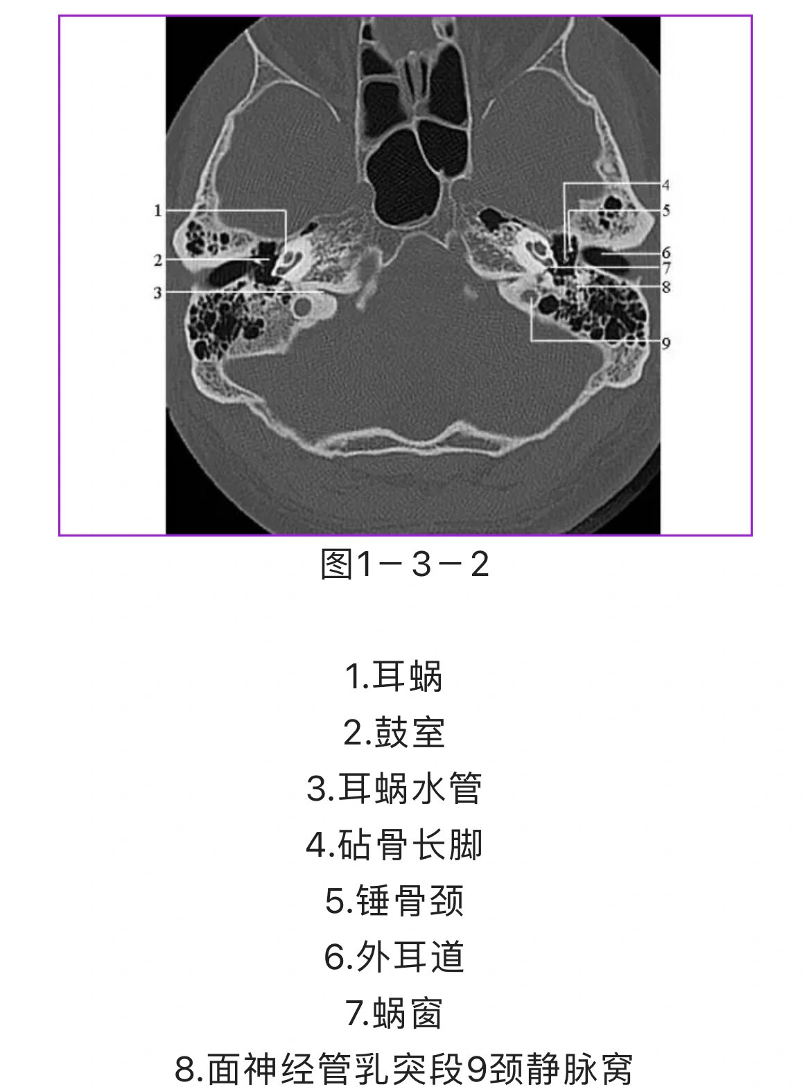 颞叶钩回疝ct解剖图片