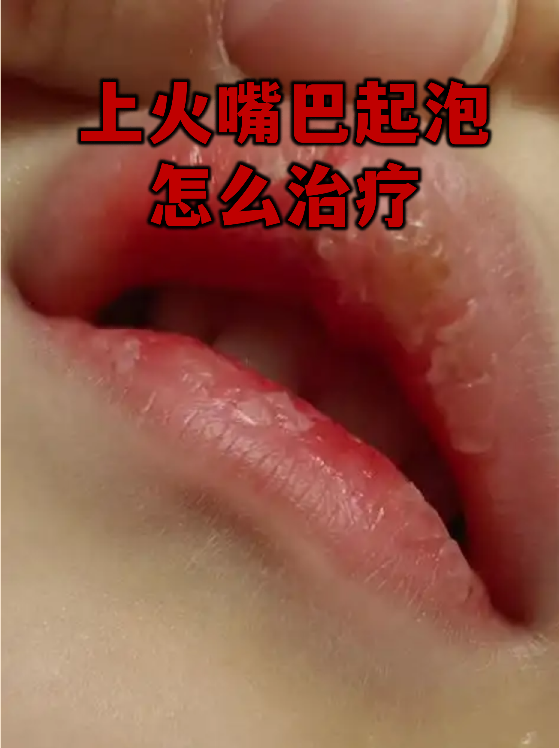 其实这是单纯疱疹病毒在作祟,当免疫力下降时就容易发作
