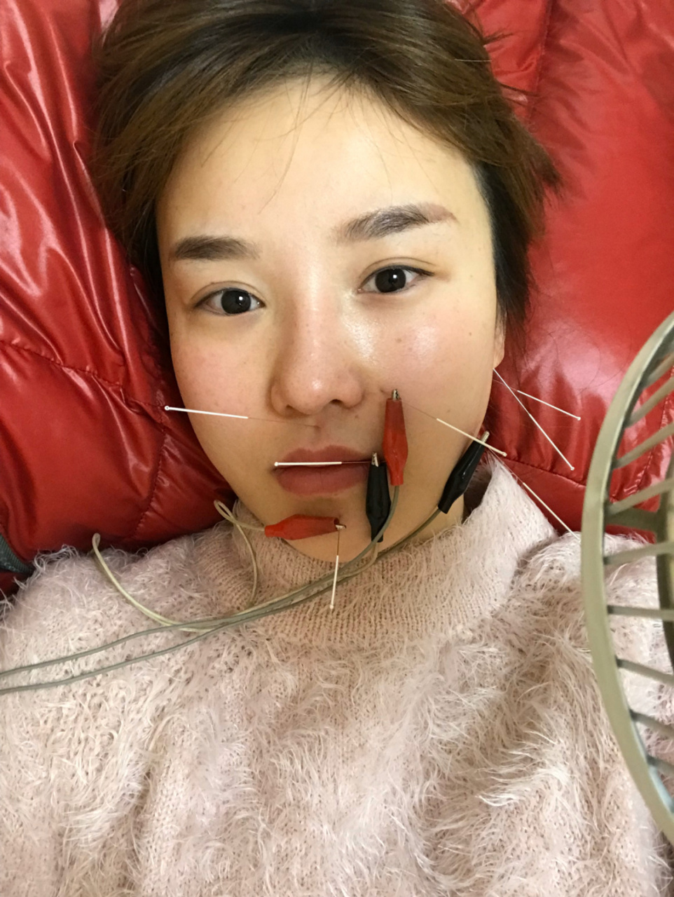 面部神经麻痹 有人私信问我有没有打过溶脂针 !