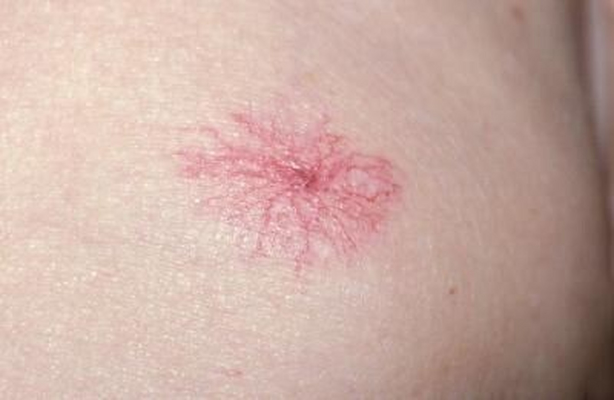 蜘蛛痣是肝病症状中比较有特异性的一种症状,但是很多人并不是十分