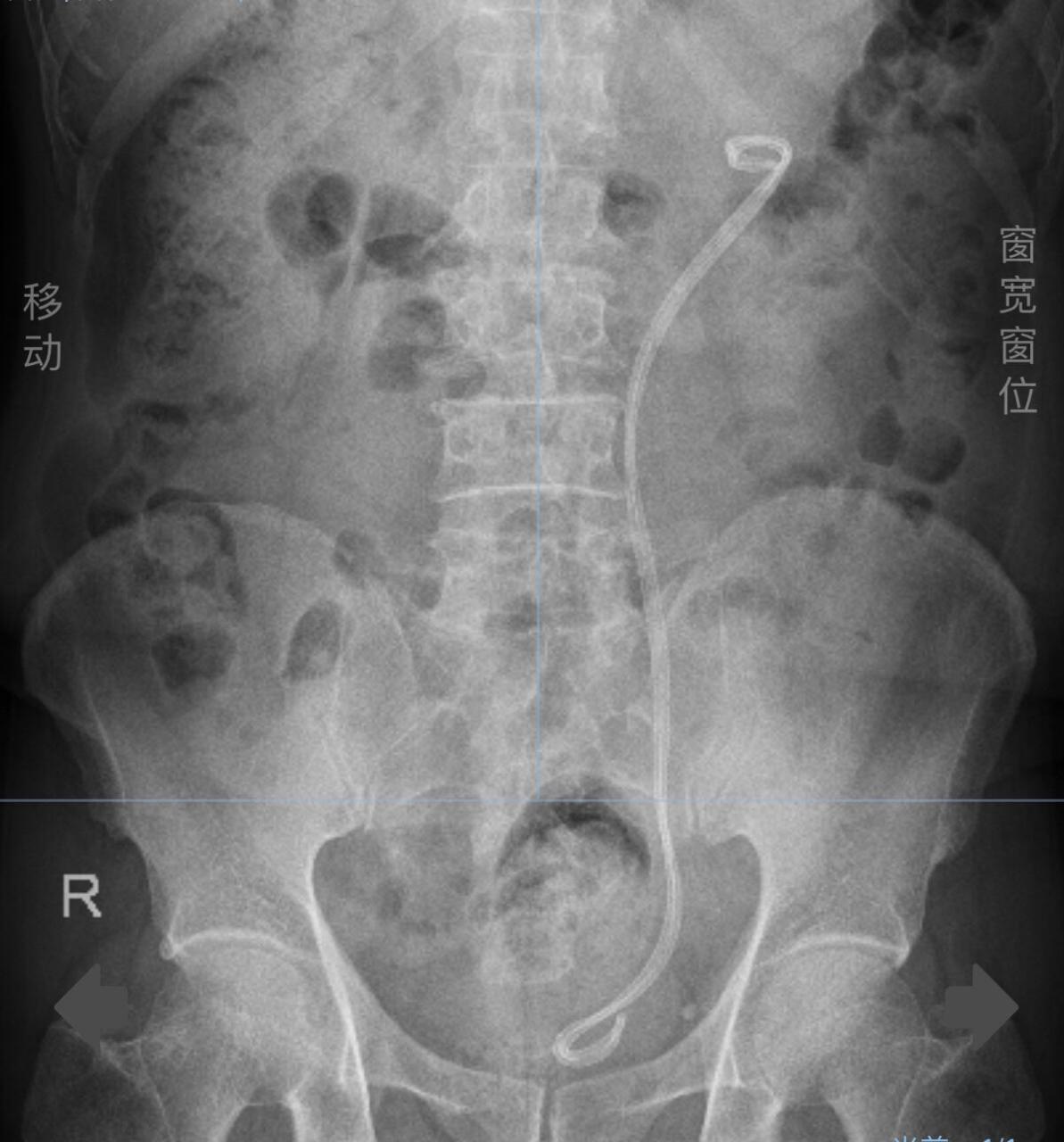 输尿管支架作用图片