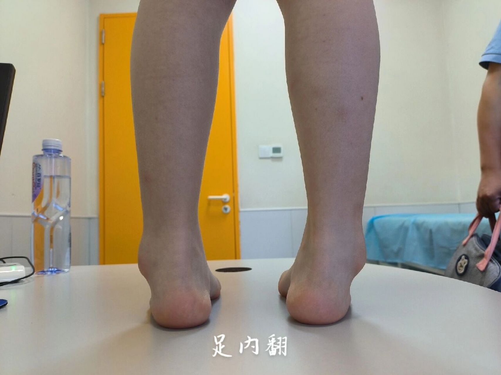 足内翻和足外翻 经常会有家长带小朋友来看脚的外观,描述的不准确.