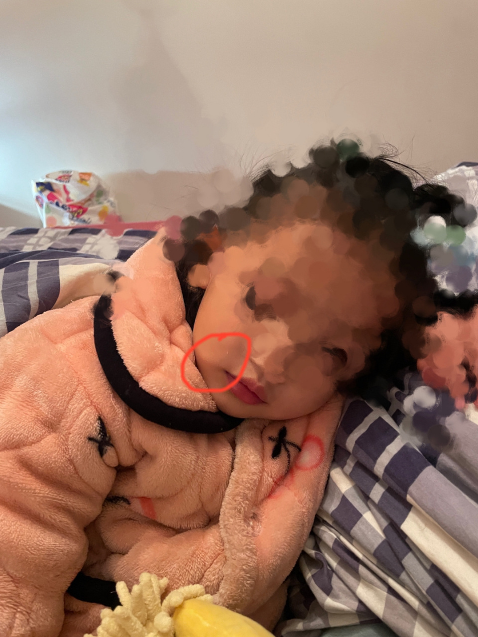 2岁小盆友嘴巴两边有这种鼓起来的包,这有关 2岁小盆友嘴巴两边有这种