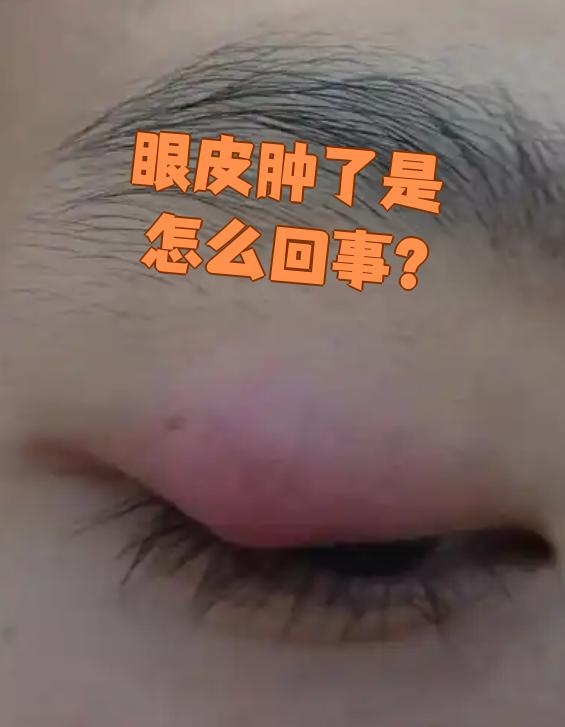 眼皮肿了常见原因包括麦粒肿,霰粒肿,蚊虫叮咬和过敏,不同情况需要