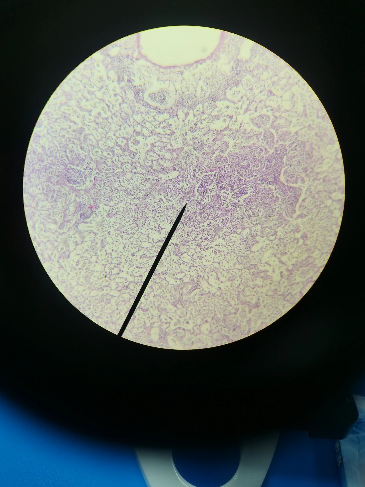 病理切片-小叶性肺炎 病理描述:镜下,不同的发展阶段,病变的表现和