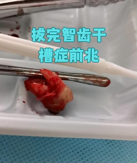 拔智齿后如果出现干槽症,最早的症状通常在术后3