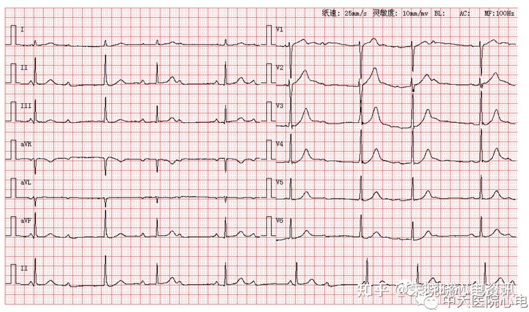 高度房室传导阻滞3交界性逸博心律