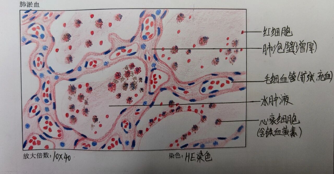 病理组织红蓝铅笔手绘图 16615肝细胞水肿 99肝小叶结构可见,肝