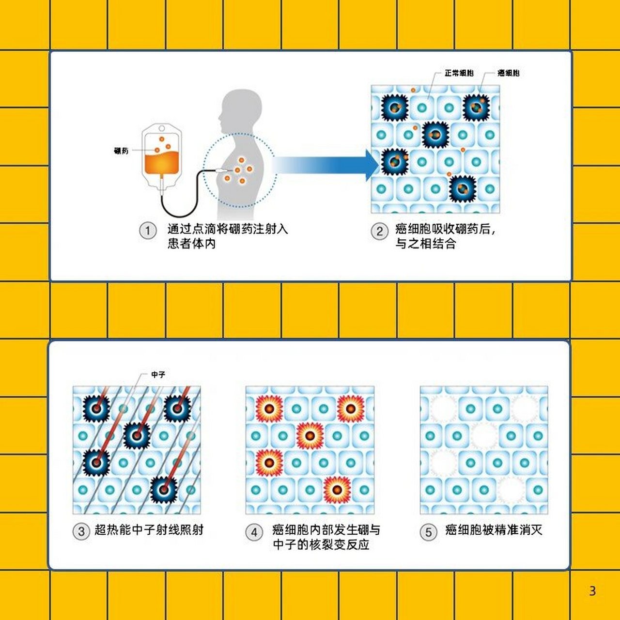 bnct是boronneutroncapturetherapy的简称,中文译作硼中子捕获疗"