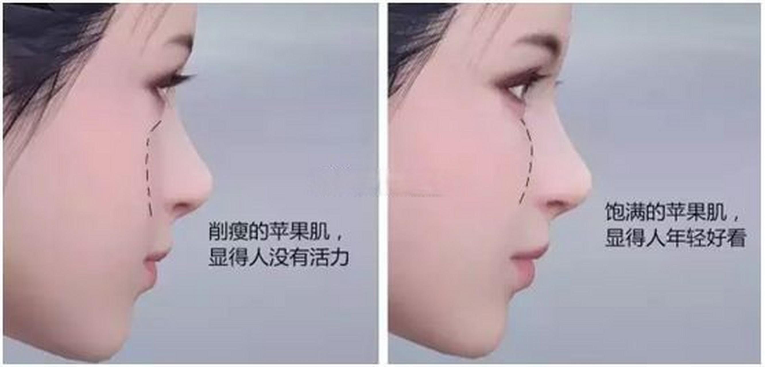 消瘦的#苹果肌# ,显得人没有活力,而饱满的苹果肌显得人年轻好看.