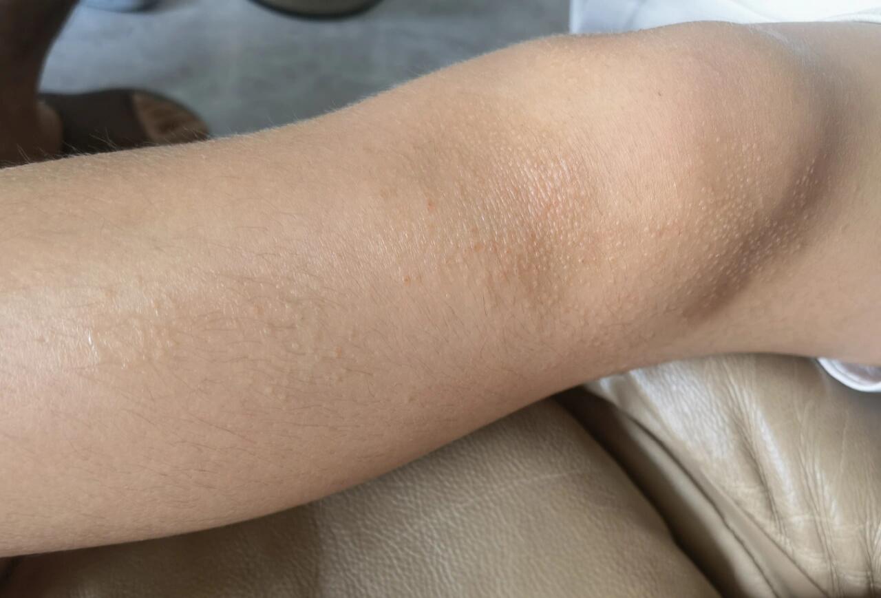 光泽苔藓…医生说不用管会自愈,但是现在脸上也长了一些,我担心会不会