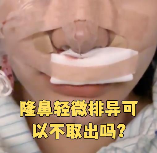 隆鼻轻微排异可以不取出吗?