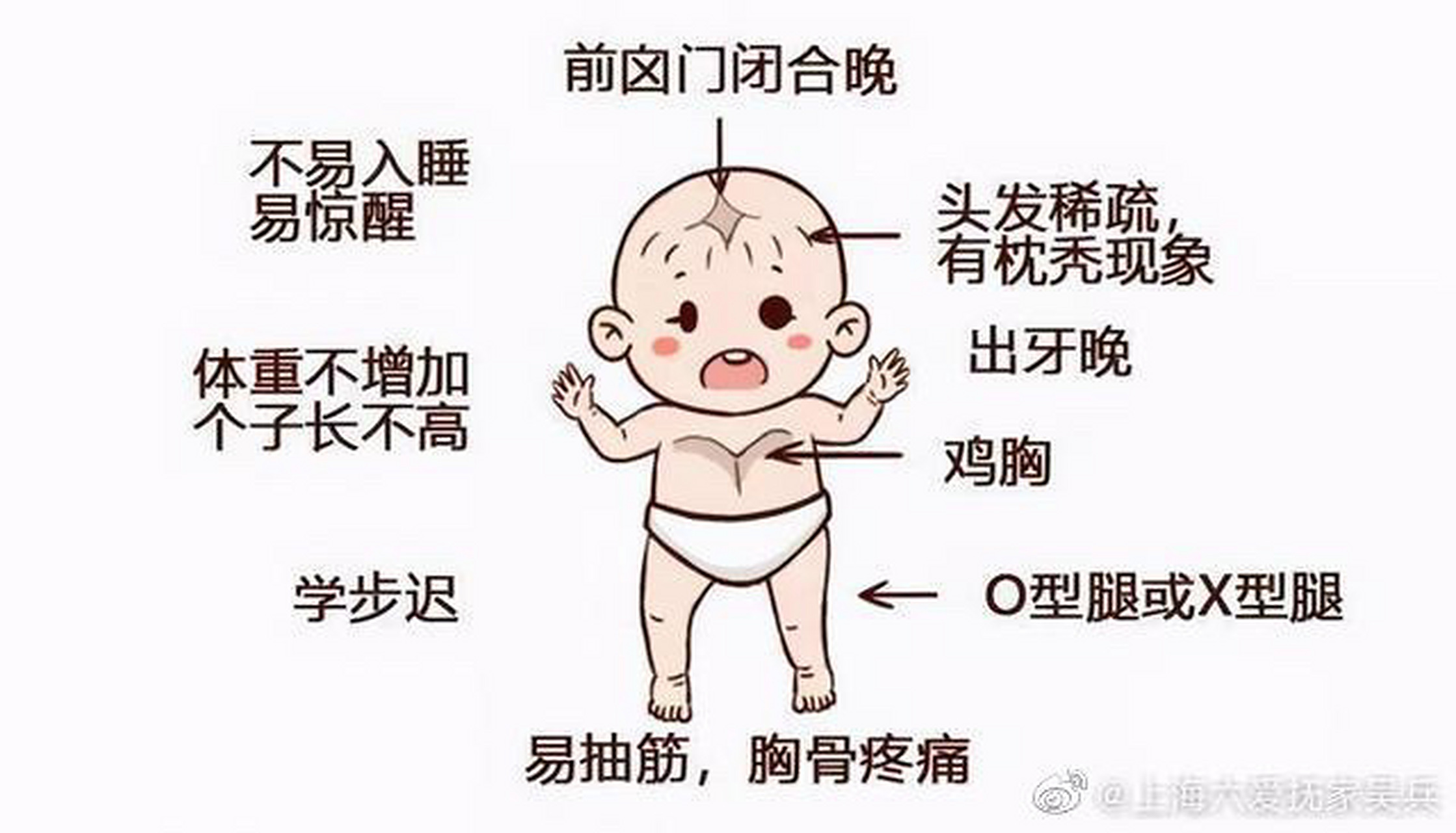 佝偻病的表现及预防 佝偻病是一种小儿常见病.