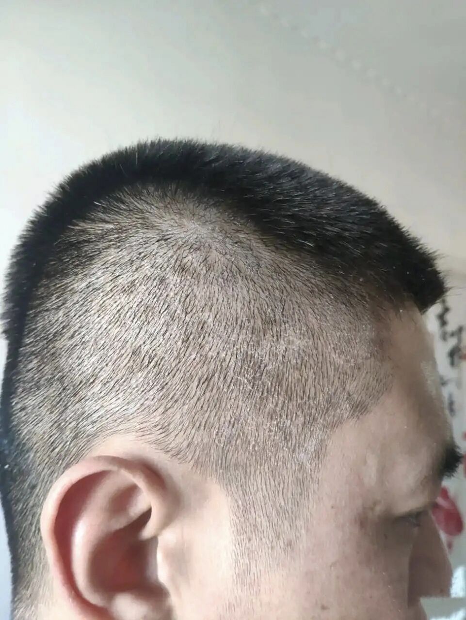 洗完头头皮起白屑,是不是洗太干净了 刚洗完头 有点干 还是有点白