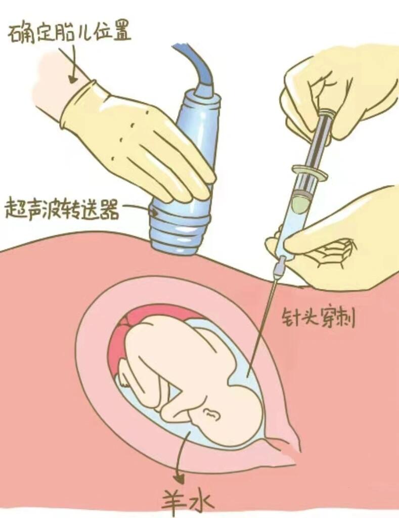 羊水穿刺后的注意事项 哈喽大家好我是92年三胎妈妈,前两胎顺风水水