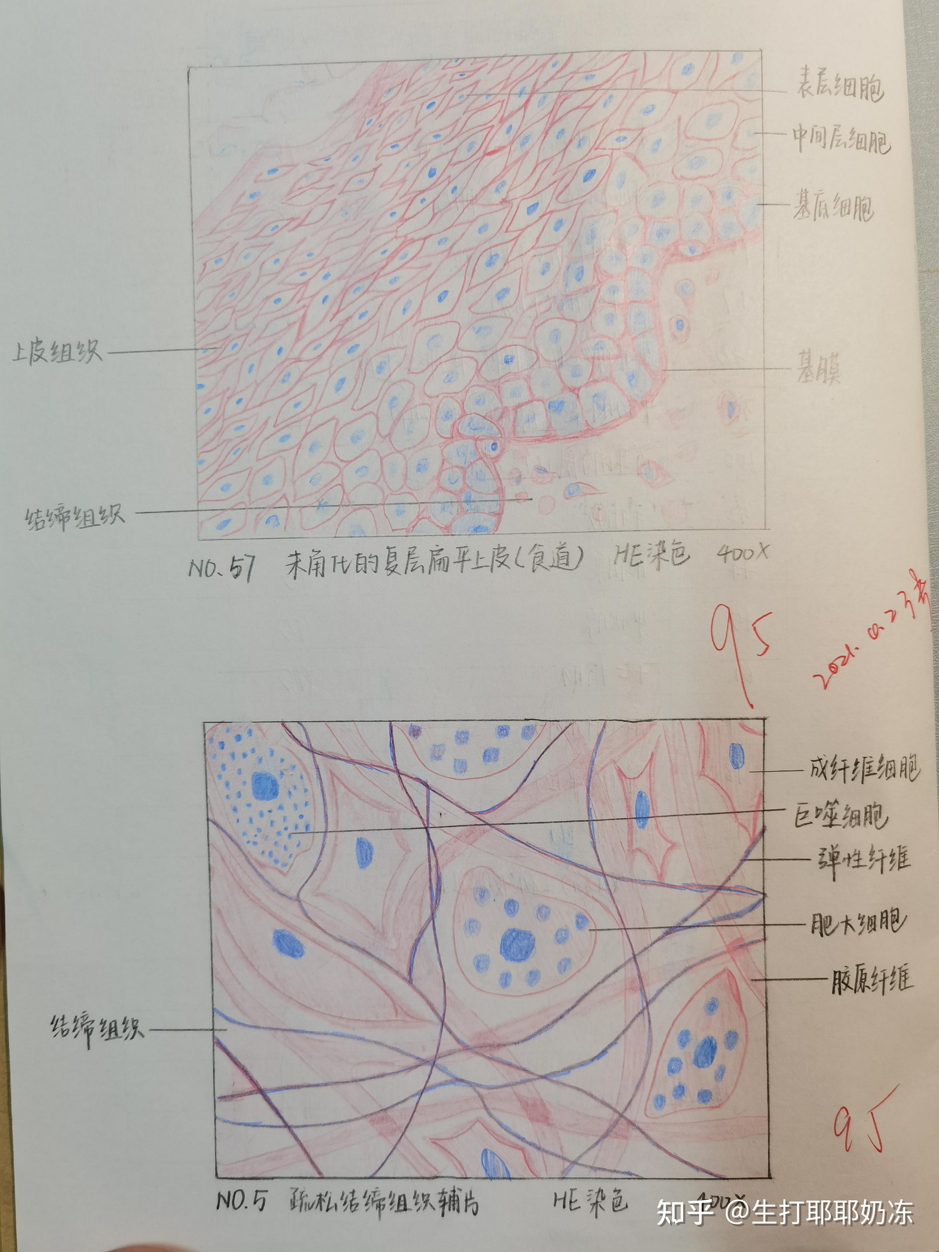 葡萄胎红蓝铅笔图图片