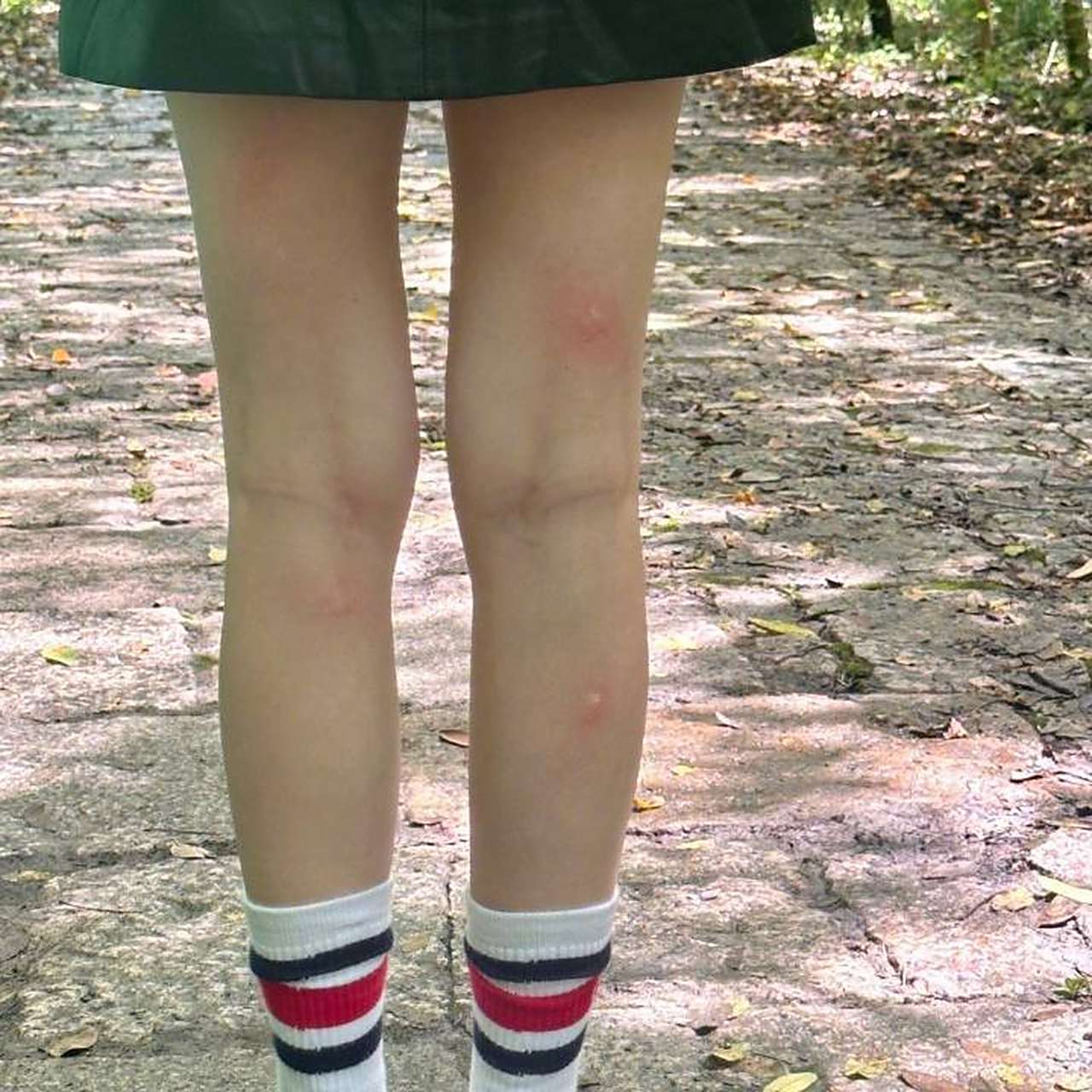 白鹿腿被蚊子叮了#    蚊子都能亲到菠萝妹,而我却不能!