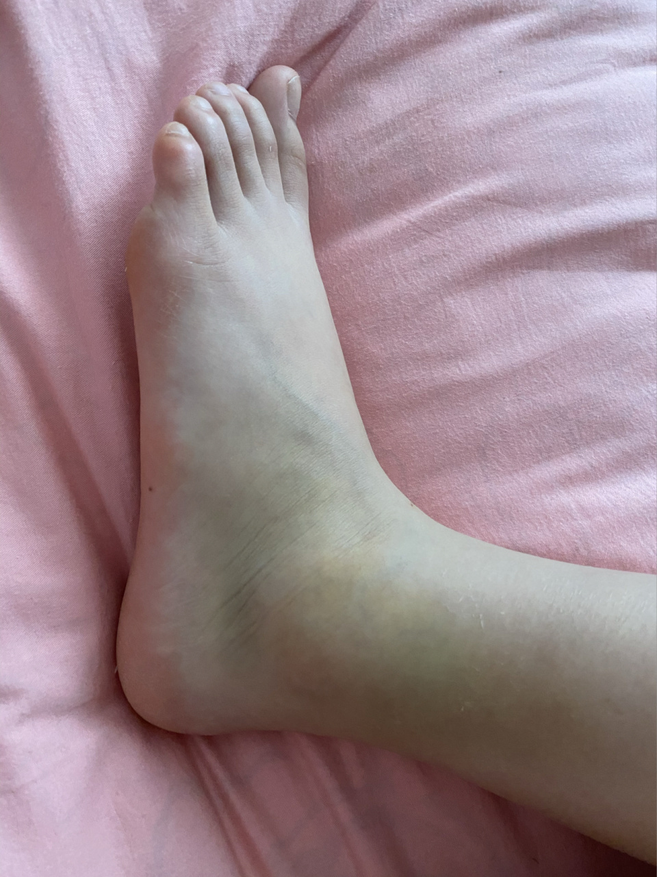 给大家参考一下,发现每个人崴脚后内外侧都会有些淤青的,不知道什么